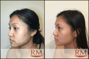 Abigail Ong Microneedling 2
