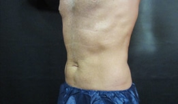 Photograph of a man's abdomen after receiving the CoolSculpting Elite treatment