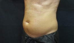 Case of a man who comes to consultation for the CoolSculpting Elite treatment