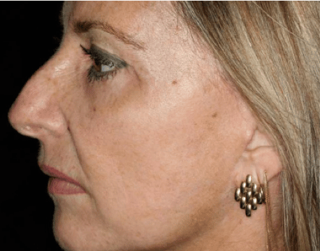 Photograph of a woman's face after receiving CO2 Fractional Skin Resurfacing treatment