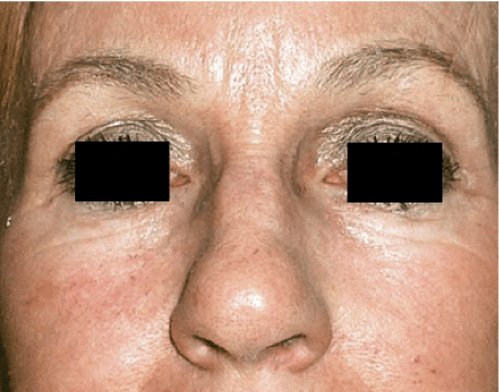 Photograph of a woman's face after receiving CO2 Fractional Skin Resurfacing treatment