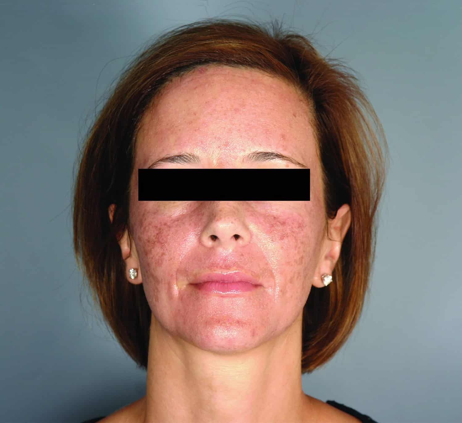 Case of a woman who attends a consultation for the CO2 Fractional Skin Resurfacing treatment
