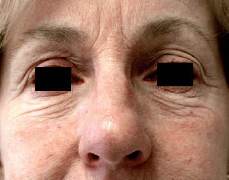 Case of a woman who attends a consultation for the CO2 Fractional Skin Resurfacing treatment