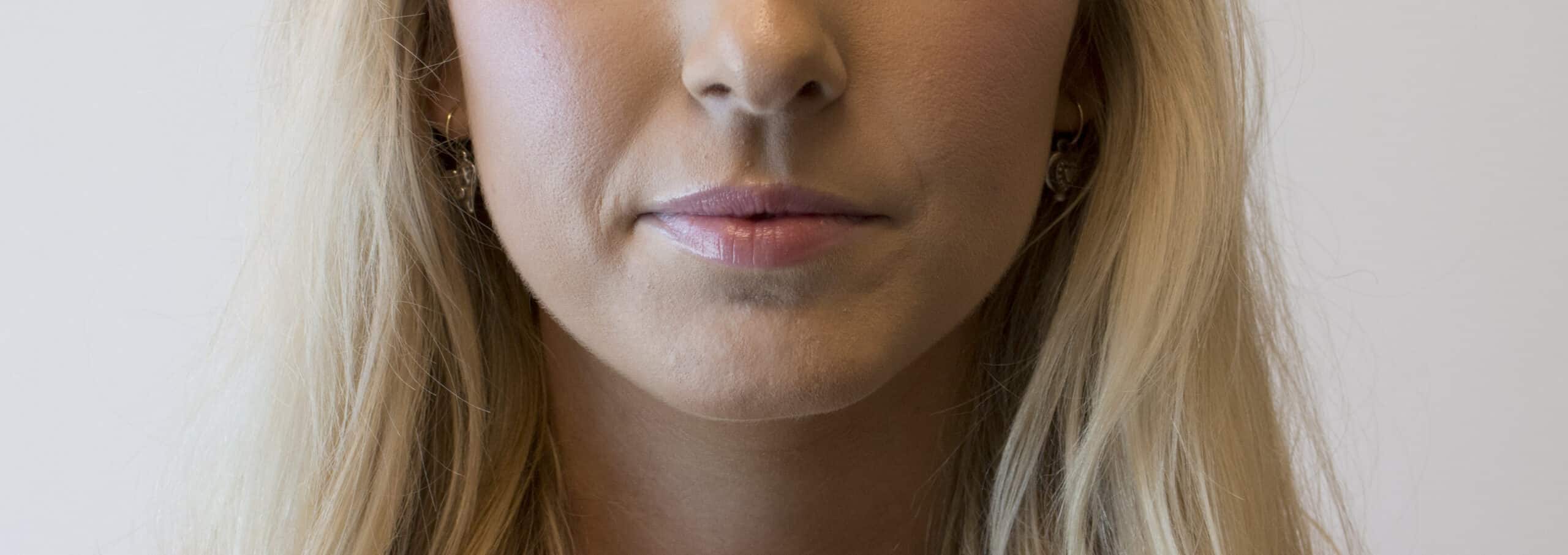 Face of a woman before receiving botox