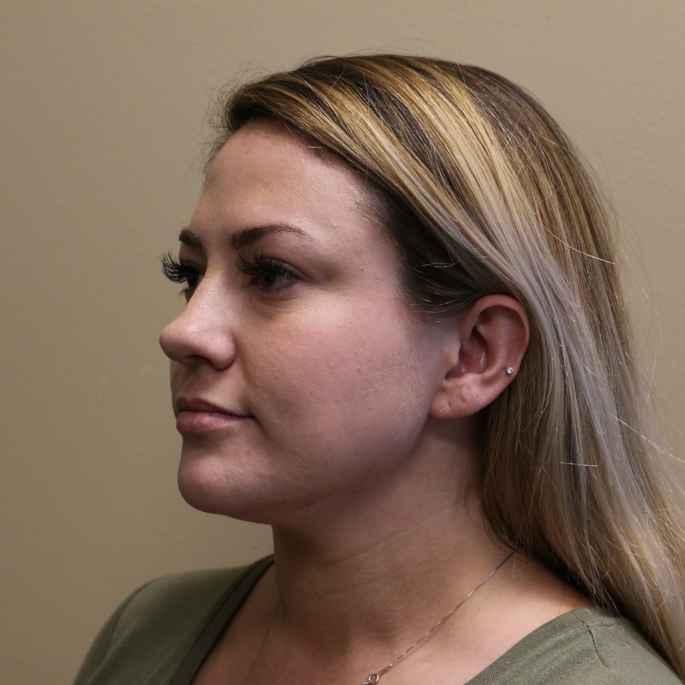 Face of a woman after her Kybella treatment