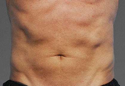 Photograph of the abdomen of a man after receiving CoolTone Treatment