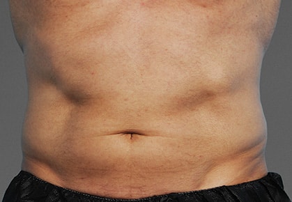 Case of the abdomen of a man who comes to consultation for the CoolTone treatment
