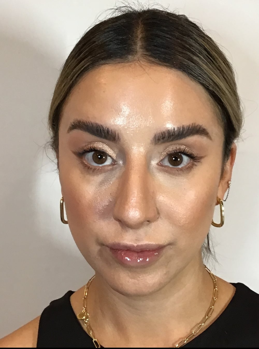 Face of a woman after her Botox treatment