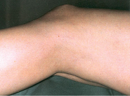 A woman's leg after receiving laser vein treatments
