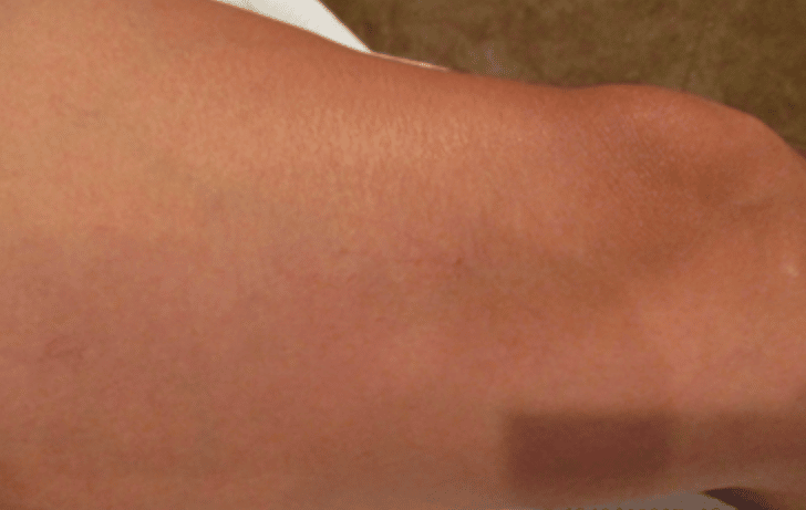 A woman's leg after receiving laser vein treatments