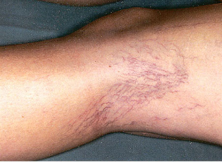 Case of a woman who attends a consultation for the Laser Vein Treatments