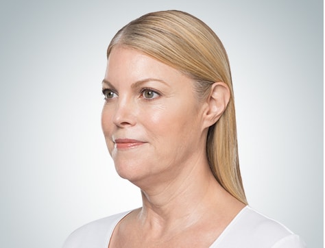 Case of a woman who comes to the clinic for Kybella treatment