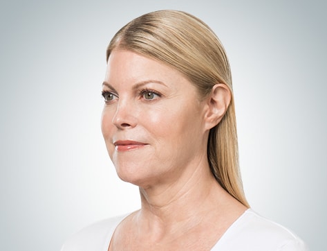 Photograph of a woman's face after receiving Kybella treatment
