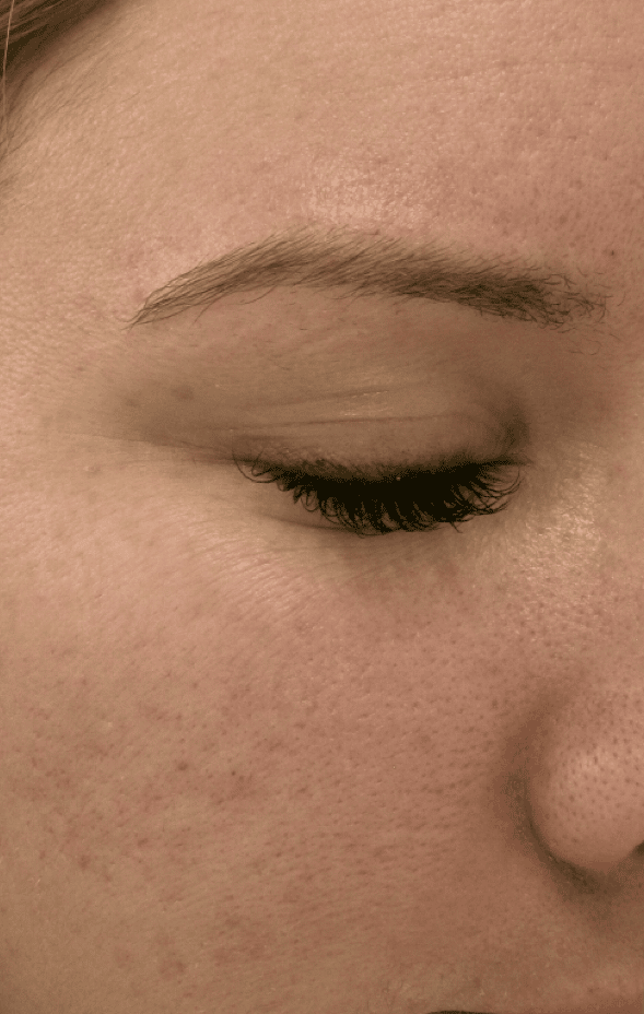 Image after Microneedling Treatments