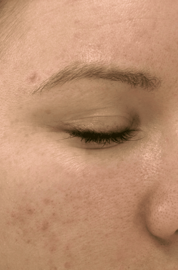 Image before Microneedling Treatments