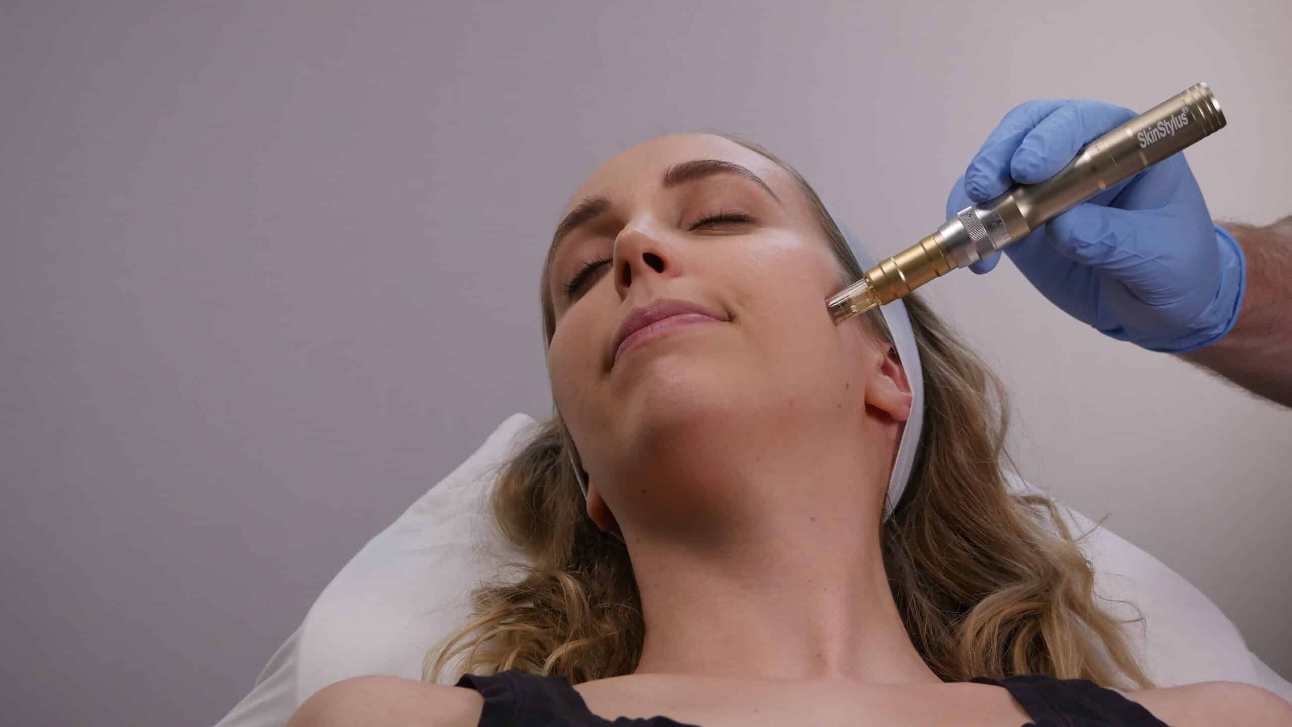 Microneedling Female face SkinStylus treatment