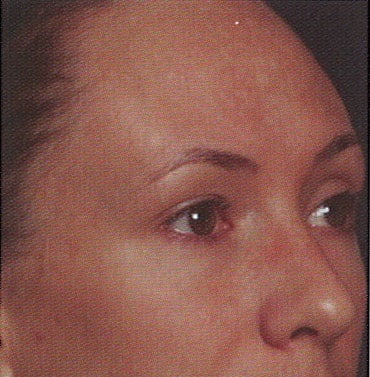 Image after Rejuvenize Treatments