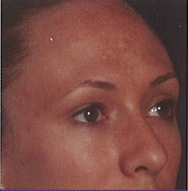 Image before Rejuvenize Treatments