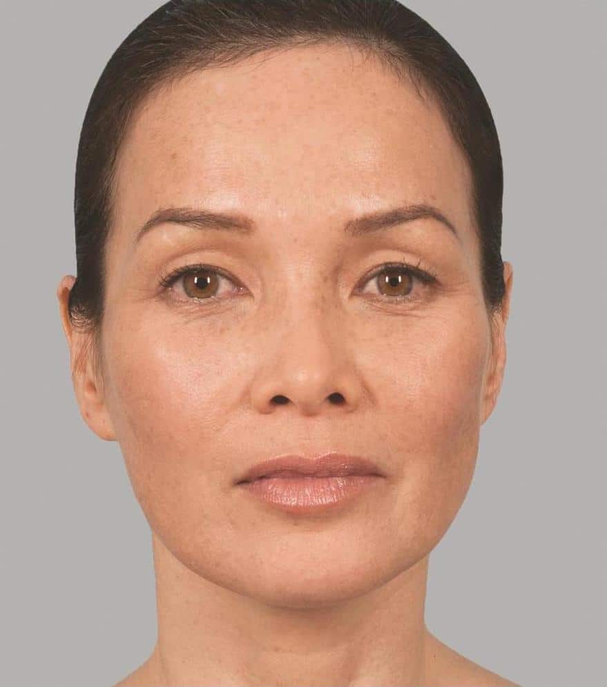 Image after Sculptra Aesthetic Treatments