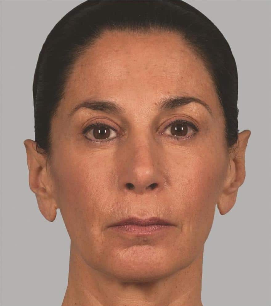 Image after Sculptra Aesthetic Treatments