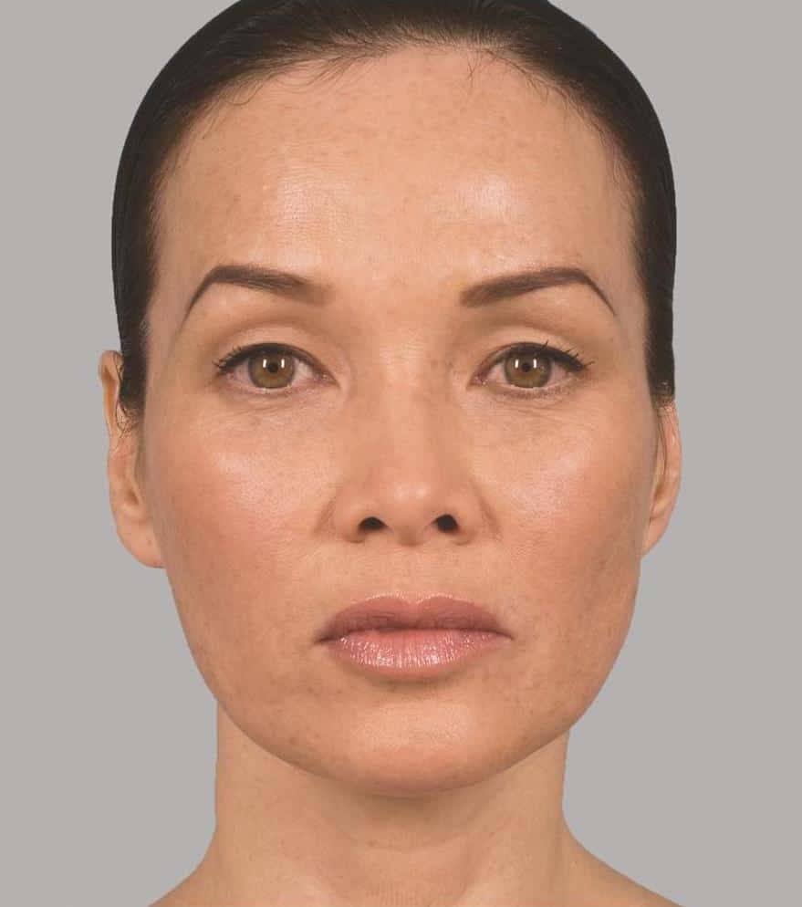 Image before Sculptra Aesthetic Treatments