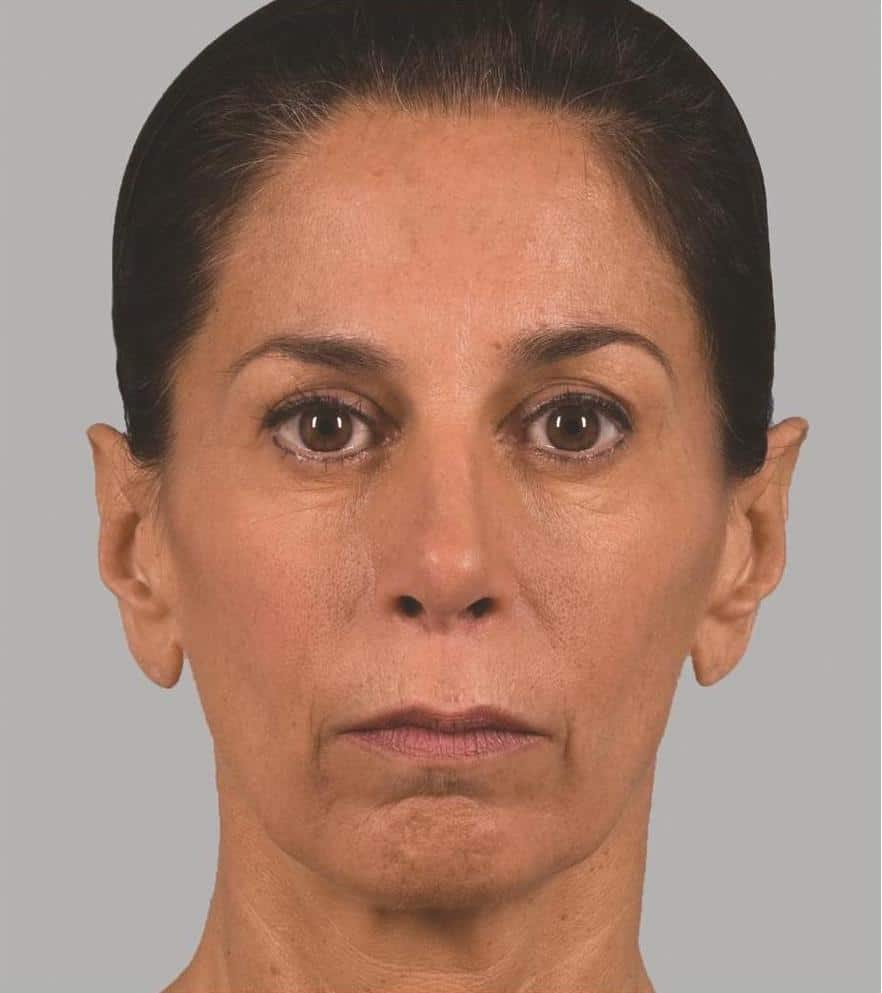Image before Sculptra Aesthetic Treatments