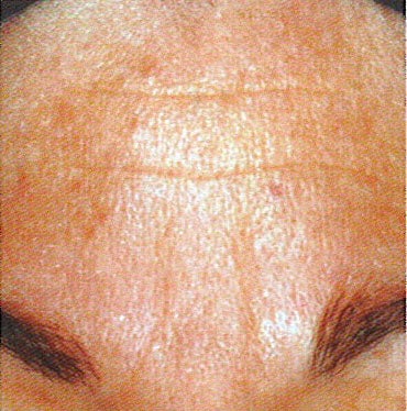 Image after Vitalize Treatments