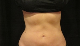 Photograph of a woman's abdomen after receiving the CoolSculpting Elite treatment