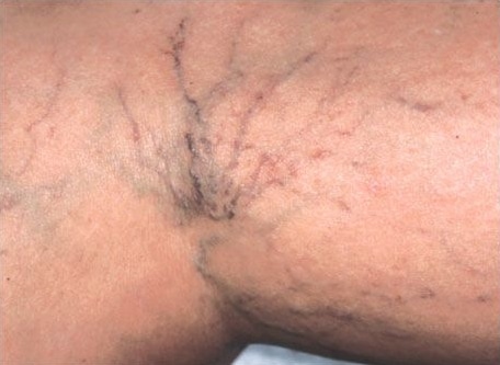 Image before Laser Vein Treatments