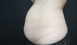 Case of a woman who comes to consultation for the CoolSculpting Elite treatment