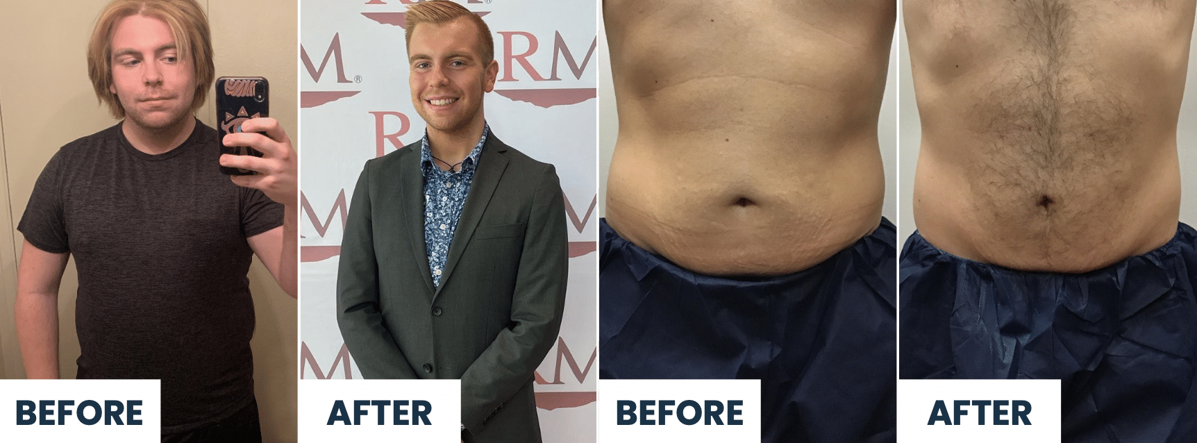 Ian C Before After CoolSculpting