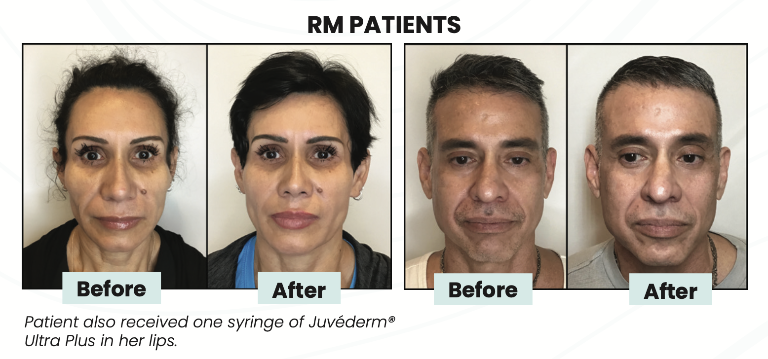 Sculptra Aesthetic Results