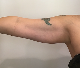 kim coolsculpting arms before
