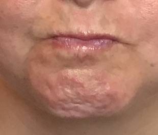 botox chin before