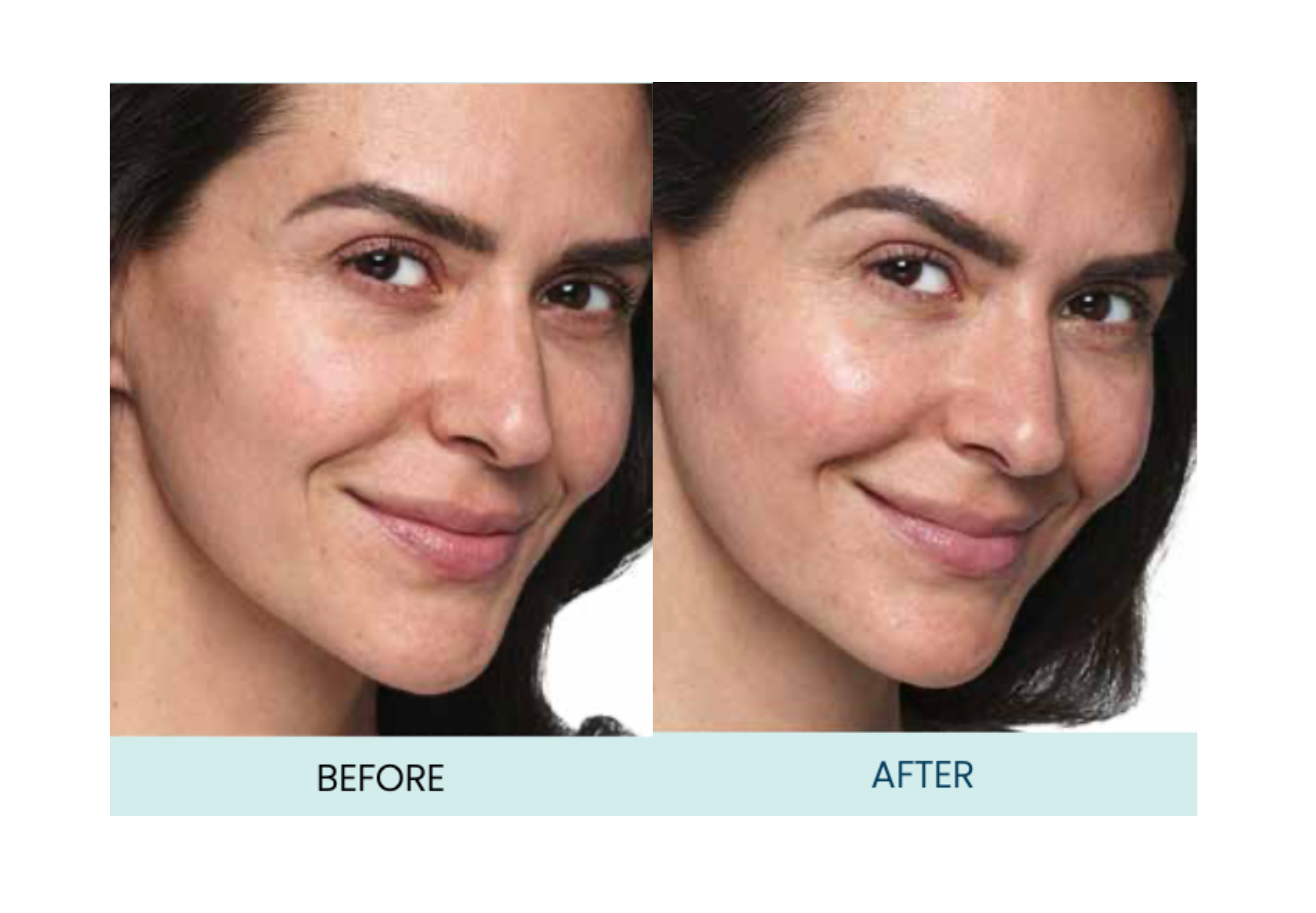SkinVive by Juvederm Before After